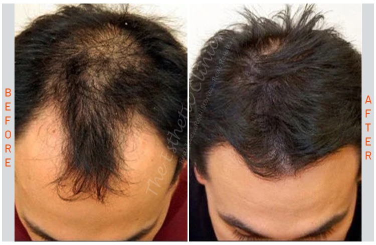 Exosomes-Hair-Treatment